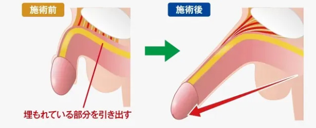 MSクリニックの切らない長茎術