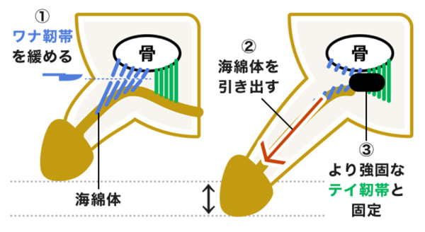 アトムクリニックの切開術(切る手術)の図