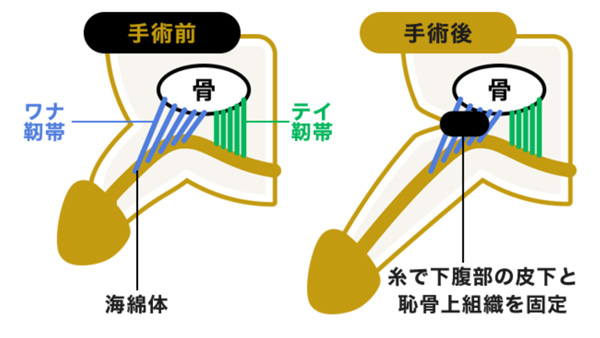 アトムクリニックのCTトライアル(切らない手術)の図