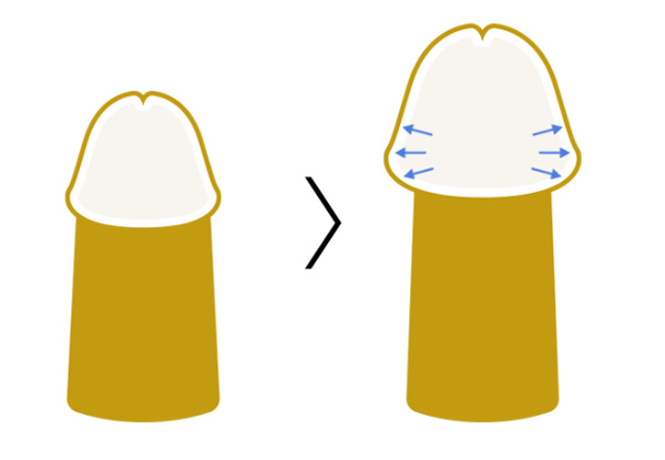 アトムクリニックのクレヴィエル法の図