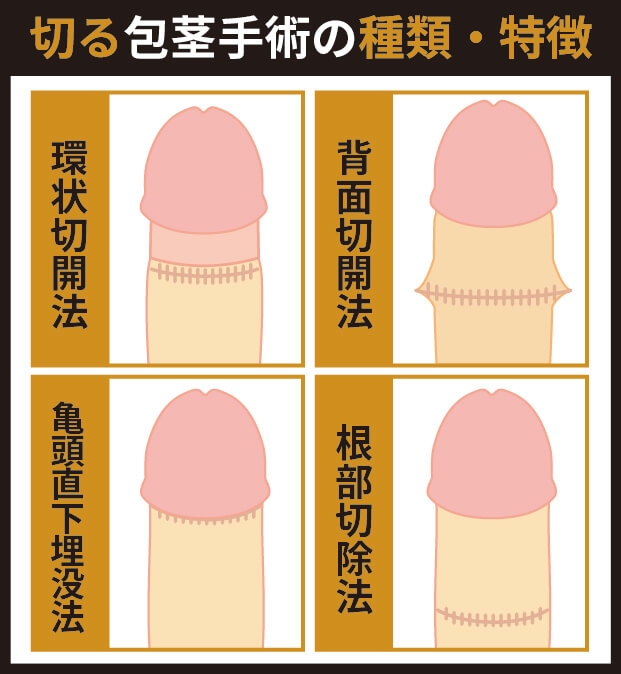 切る包茎術の種類と特徴