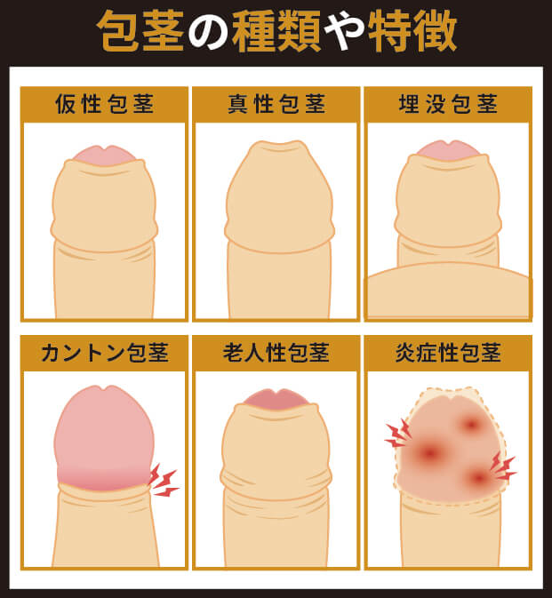 包茎の種類や特徴