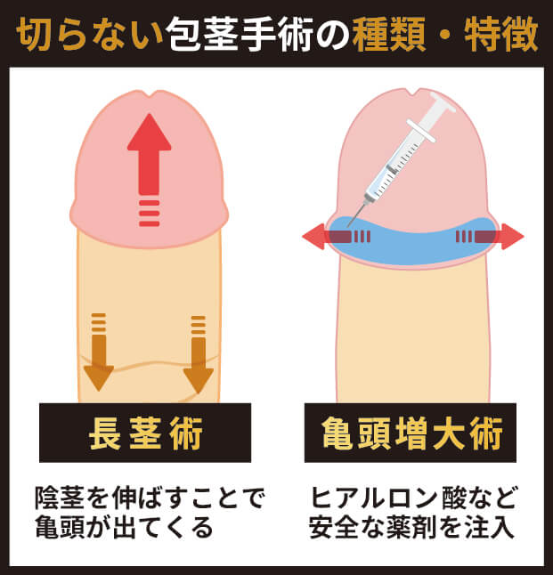 切らない包茎術の種類と特徴