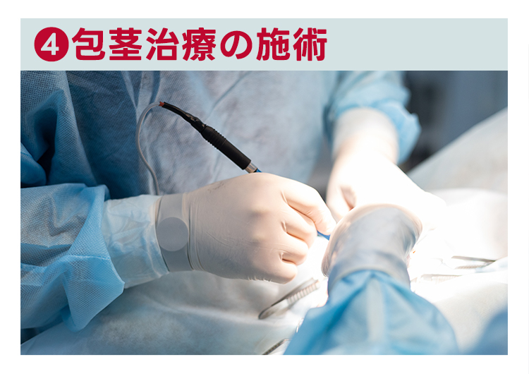 包茎治療の施術