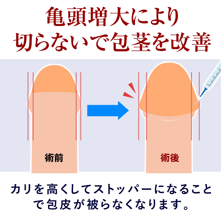 亀頭増大により切らないで包茎を改善