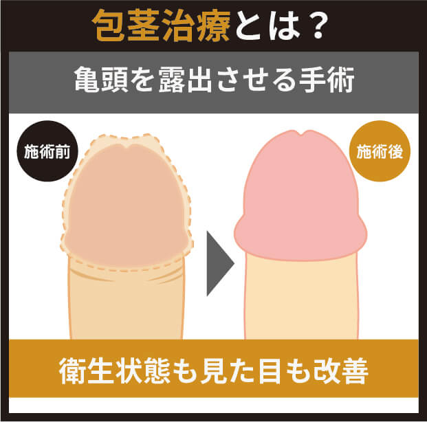 包茎治療とは