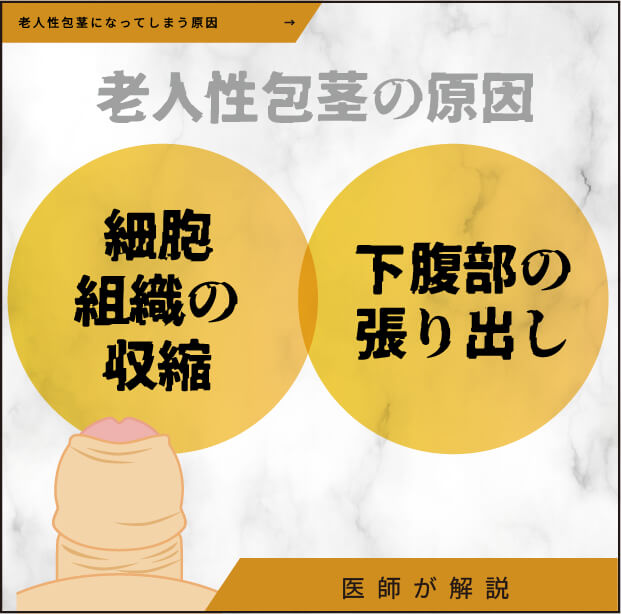 老人性包茎になってしまう原因