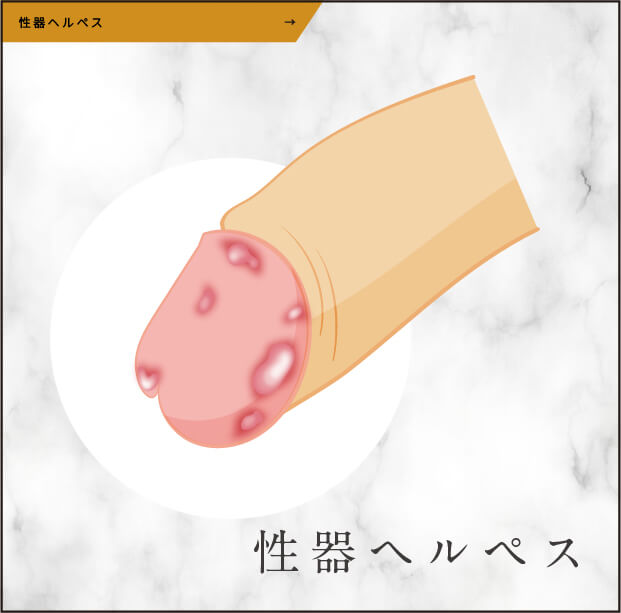 性器ヘルペス