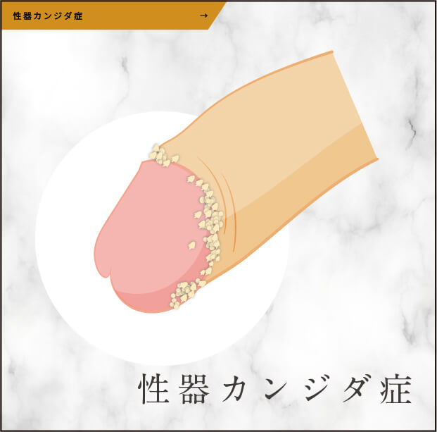 性器カンジダ症