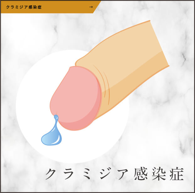 クラミジア感染症