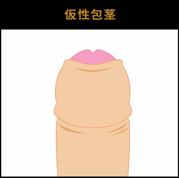 仮性包茎