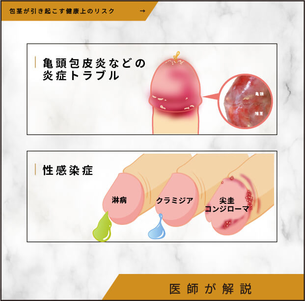 包茎の放置が引き起こす健康上のリスク
