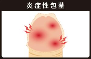 炎症性包茎