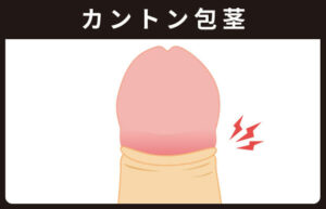 カントン包茎