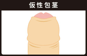 仮性包茎