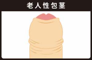 老人性包茎