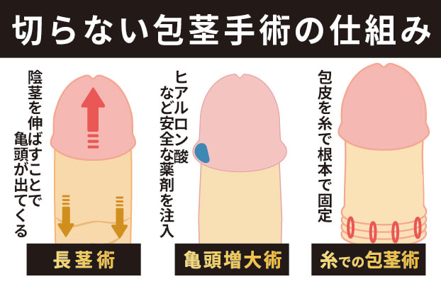 切らない包茎術の仕組み