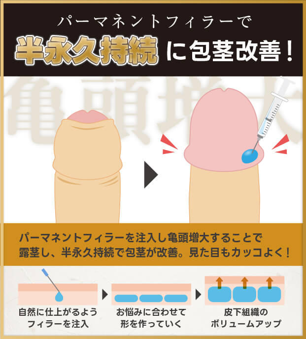 パーマネントフィラーで半永久持続の亀頭増大で包茎治療