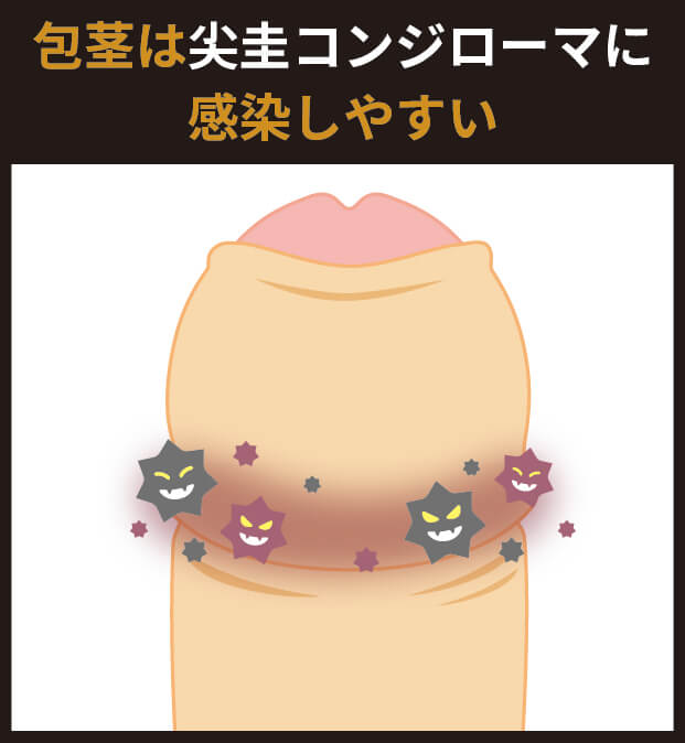 包茎は尖圭コンジローマに感染しやすい