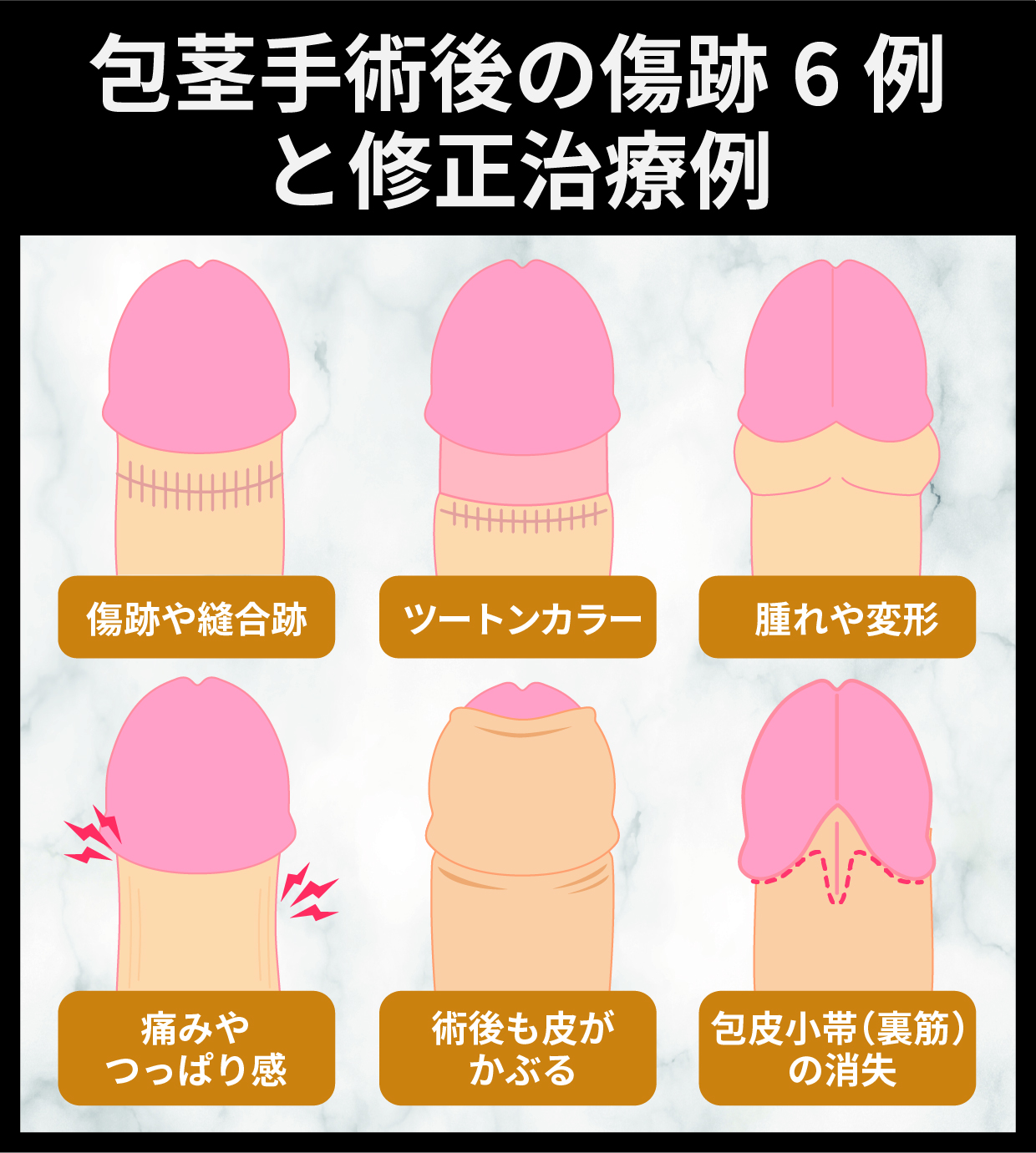 包茎手術後の傷跡6例と修正治療例
