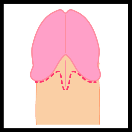 包皮小帯（裏筋）の消失