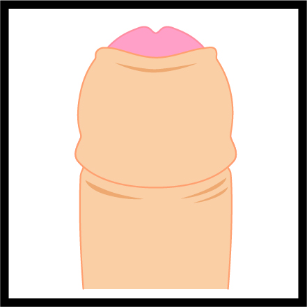 術後も皮が被る