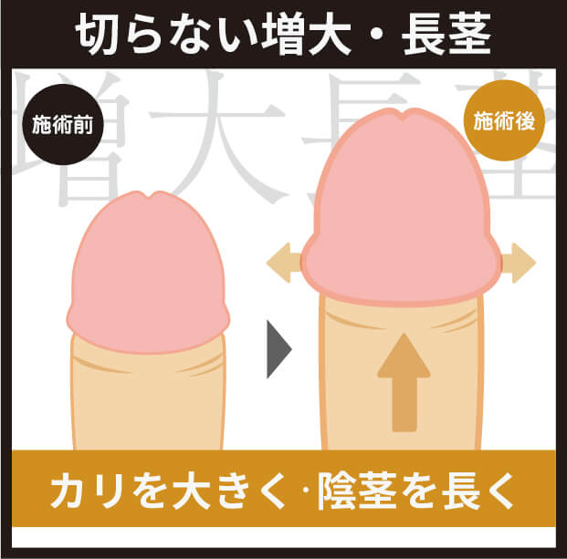 切らない増大・長茎とは?