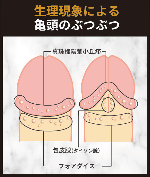 生理現象による亀頭のぶつぶつ