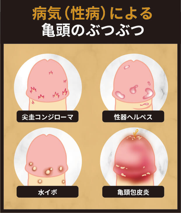 病気（性病）による亀頭のぶつぶつ