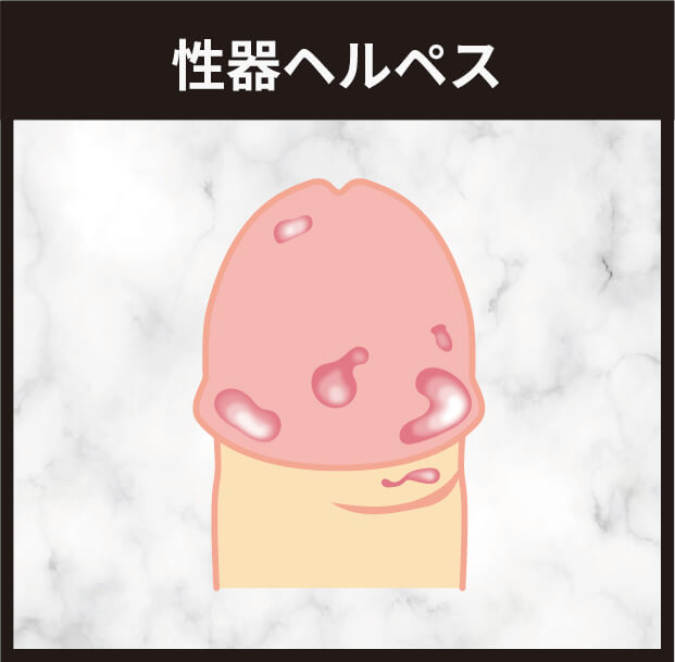 性器ヘルペス