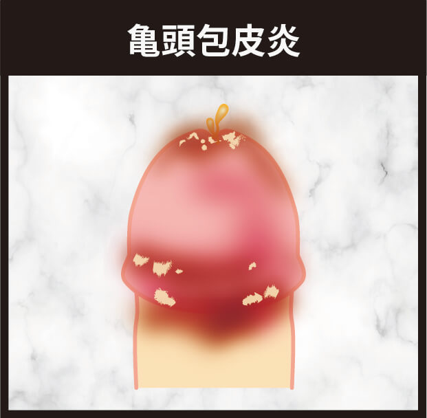 亀頭包皮炎