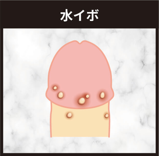 水イボ