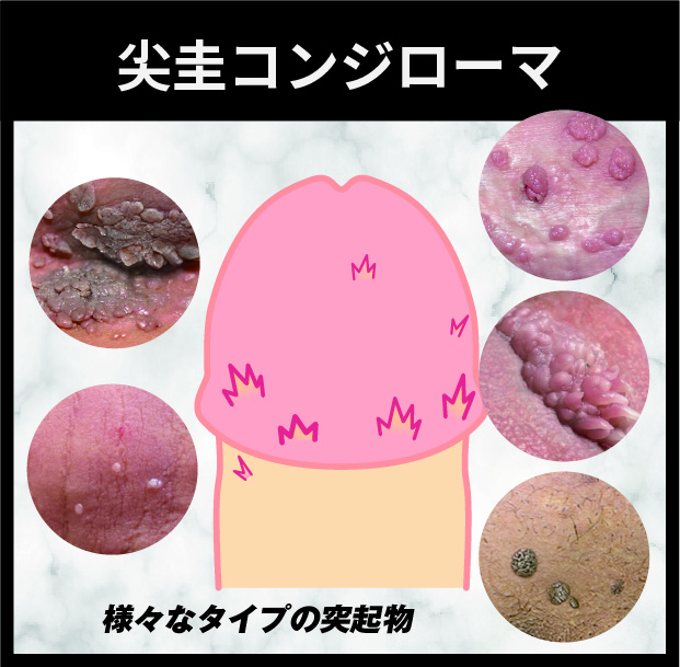 様々な形状の突起物ができる【尖圭コンジローマ（コンジローム）】