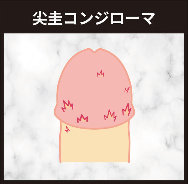 尖圭コンジローマ