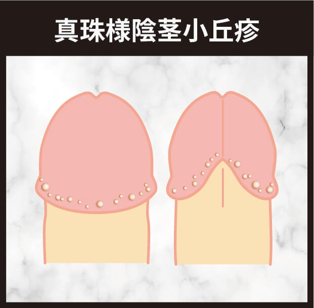 真珠様陰茎小丘疹