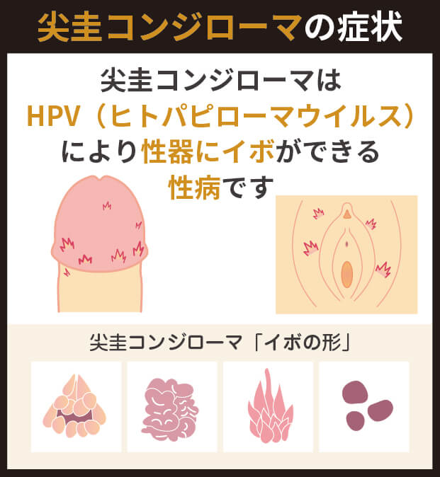 尖圭コンジローマの症状