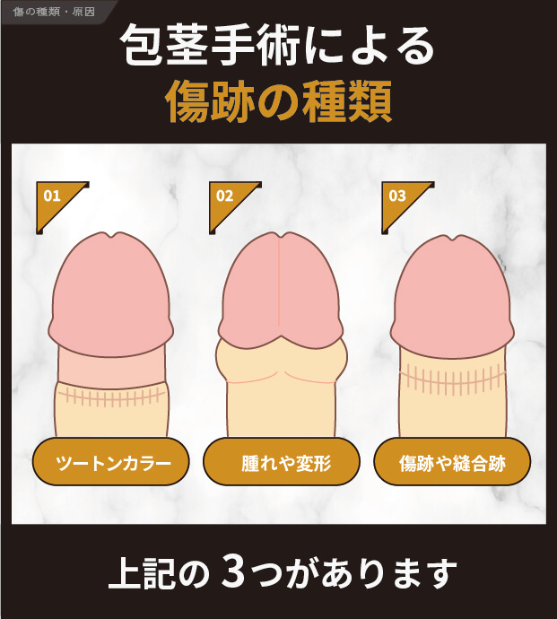 包茎手術による傷跡の種類
