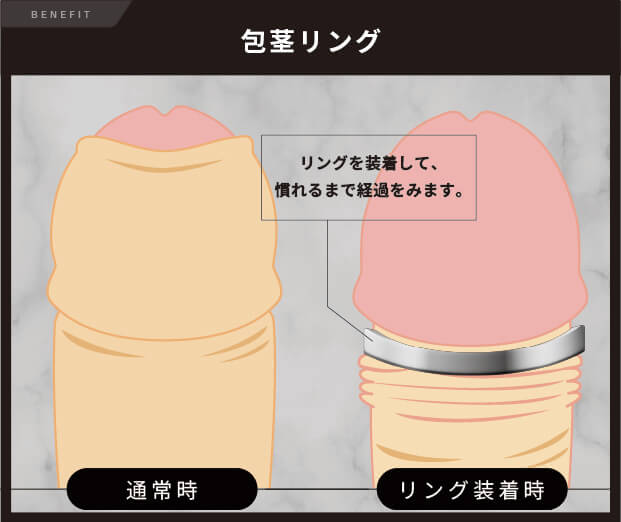 包茎リングとは？