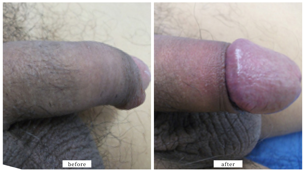 【症例001】亀頭増大術