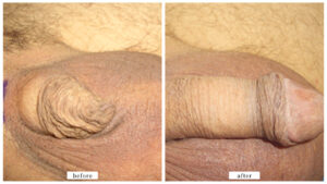 【症例011】長茎術