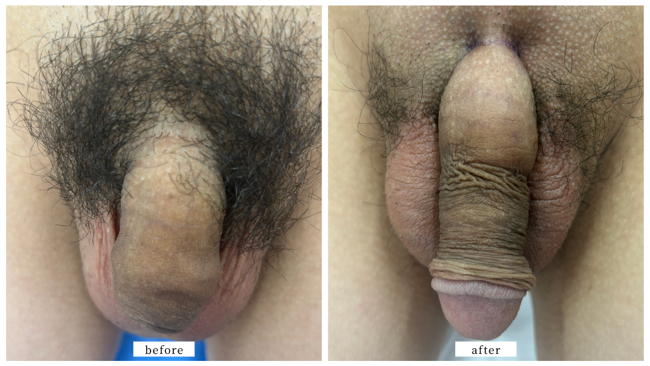 【症例012】長茎術