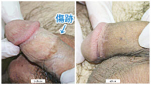 【症例013】他院修正（ツートンカラー）