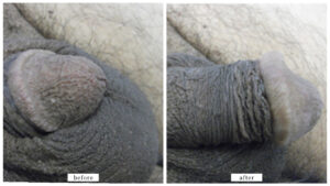 【症例014】亀頭増大術＋長茎術