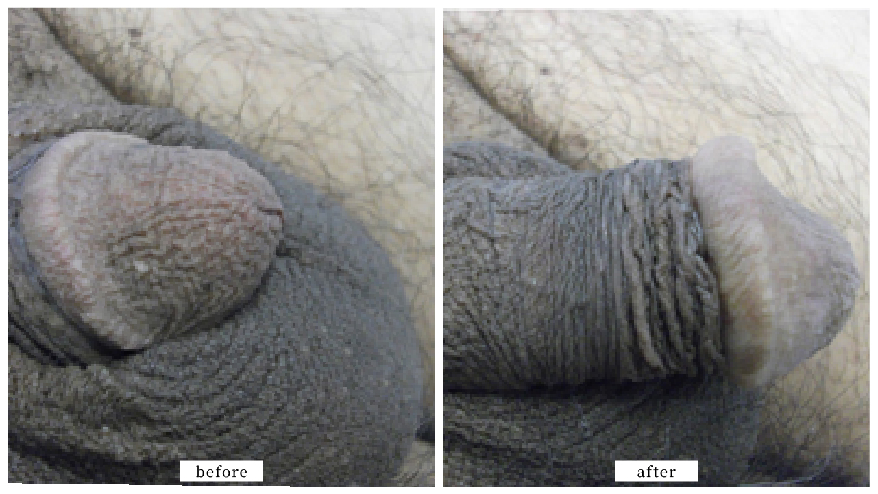 【症例014】亀頭増大術＋長茎術