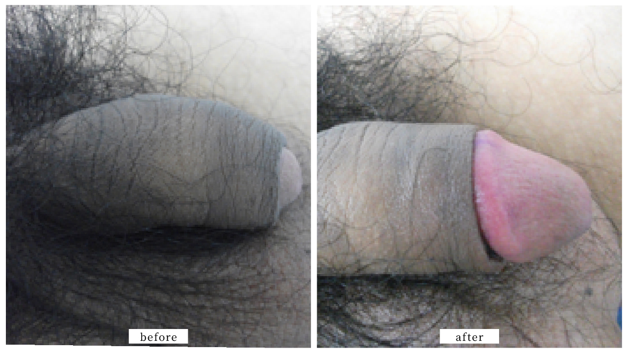 【症例016】亀頭増大術