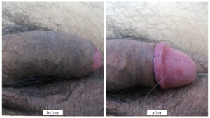 【症例017】亀頭増大術