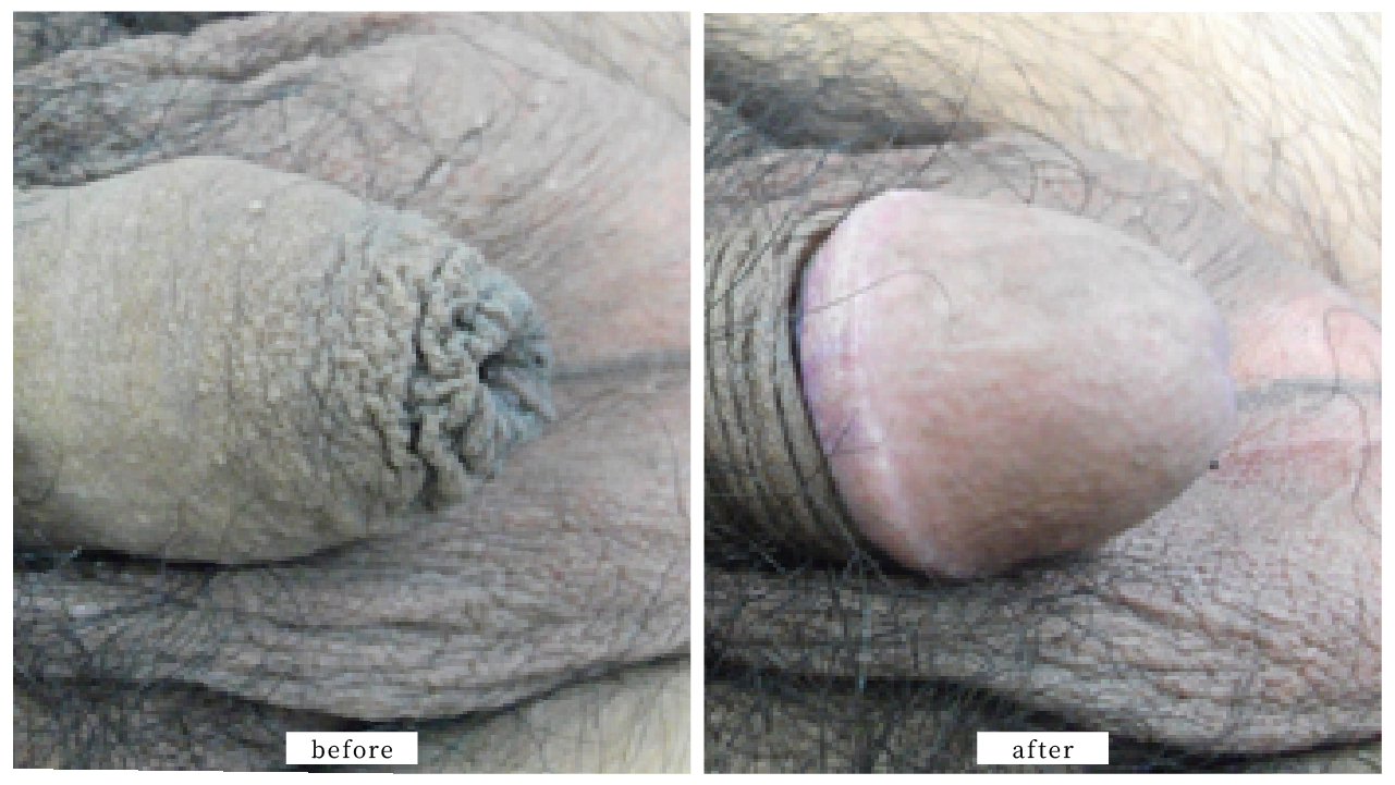 【症例018】亀頭増大術