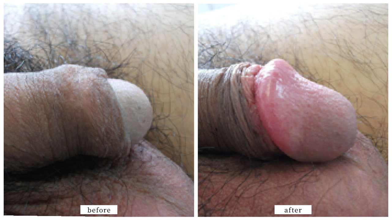 亀頭増大術ビフォー・アフター