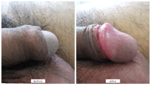 【症例019】亀頭増大術