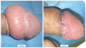 【症例002】カントン包茎